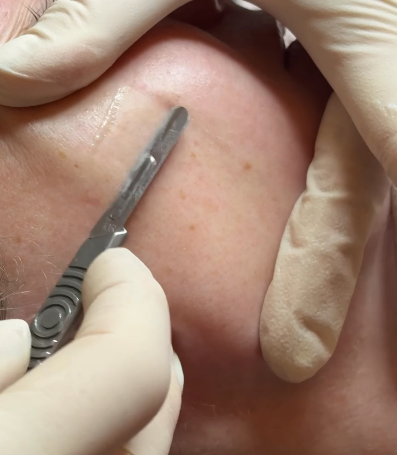 Professional dermaplaning treatment